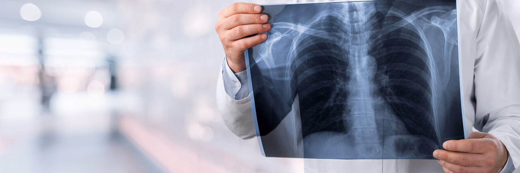 What Can Asbestos Cause Beyond Mesothelioma?