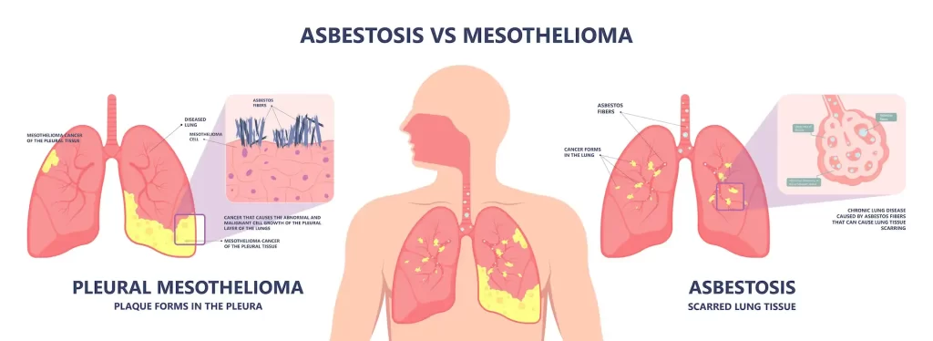 Lung Cancer And Mesothelioma